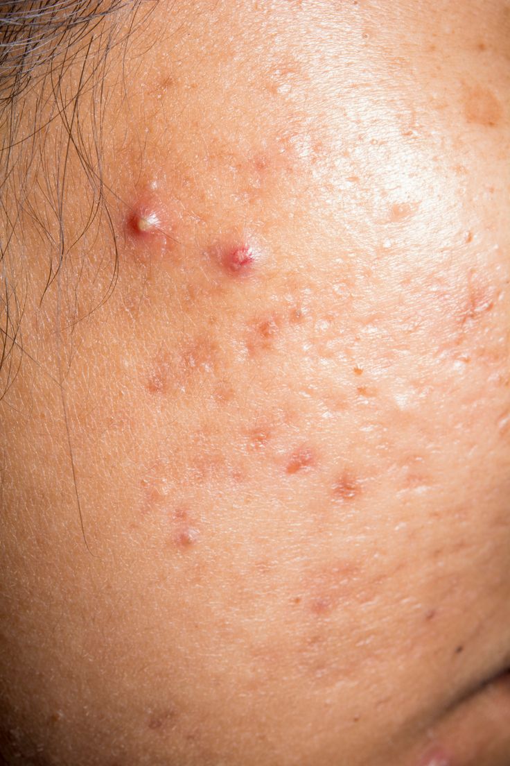 Active Acne