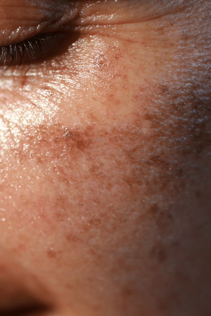 Pigmentation